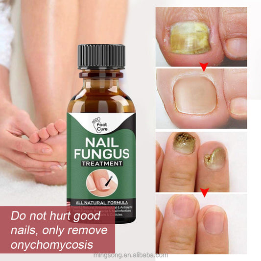 Famedeals.pk™ - Nail Fungi Treatment Serum